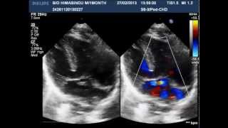 Situs Inversus Mesocardia [upl. by Oilenroc]