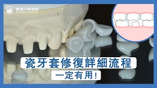 瓷牙套修復詳細流程深圳瓷牙套安唔安全？上深圳做瓷牙冠全流程程序！ [upl. by Shelah]