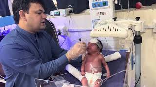 Insertion of Nasogastric Tube in Newborn [upl. by Halilak40]