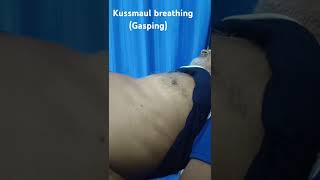 Kussmaul Breathing [upl. by Adnaloy]