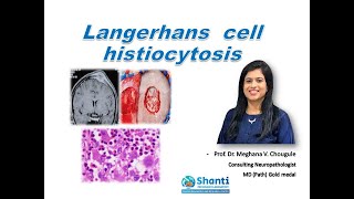 Langerhans cell histiocytosis [upl. by Ellersick]