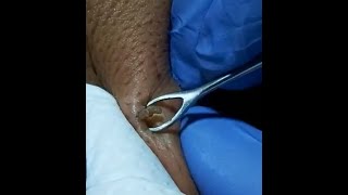 LARGE DEEP BLACKHEAD on back squeezed out Original ASMR [upl. by Esirtal]