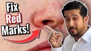 Redness Around Nose  Get Rid of Perioral Dermatitis FAST [upl. by Fortin]