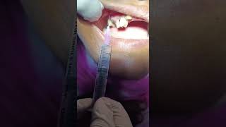 Local Infiltration anesthesia LIA  Upper Premolar  DrteethSohel semapur [upl. by Anitel]