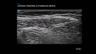 Thigh Ultrasound Lateral Femoral Cutaneous Nerve LFCN Block for Meralgia Parasthetica [upl. by Kaz]