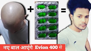 Evion 400 capsule के फायदे EVION 400 VITAMIN E CAPSULE FOR HAIR GROWTH Evion 400 for hairDhru Rao [upl. by Paterson927]