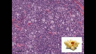 Histopathology  Nodular Lymphocyte Predominant Hodgkin Lymphoma [upl. by Pedro]