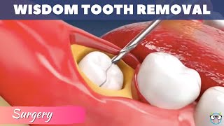 Wisdom teeth removal  Wisdom teeth extraction  Tooth extraction animation [upl. by Toma]