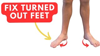 Fix TURNED OUT Feet with Two Easy Exercises duck feet [upl. by Odnomor]