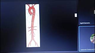 aneurisma toracoabdominal [upl. by Stanleigh]