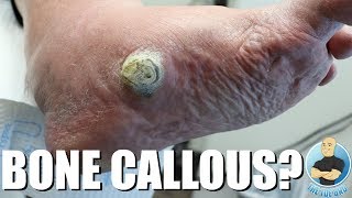 HUGE CALLOUS DUE TO COLLAPSED ARCH EXTREME CALLOUS REMOVAL [upl. by Eyllib]