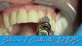 Painless and Profound Maxillary Anterior Local Anesthesia  Dental Minute with Steven T Cutbirth [upl. by Humble]