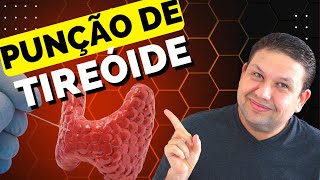 PUNÇÃO DE NÓDULO DE TIREÓIDE COMO É FEITO O EXAME  PAAF da tireóide Punção de nódulos da tireóide [upl. by Yralih]