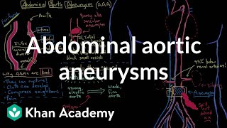 Abdominal aortic aneurysms  Circulatory System and Disease  NCLEXRN  Khan Academy [upl. by Nylanna85]