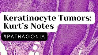 Keratinocyte Tumors Kurt’s Notes pathagonia [upl. by Sik]