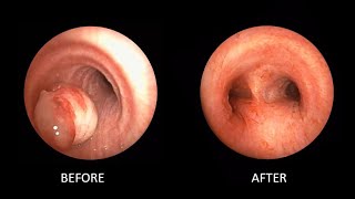 ENDOBRONCHIAL LEIOMYOMA  BRONCHOSCOPIC RESECTION [upl. by Belter]