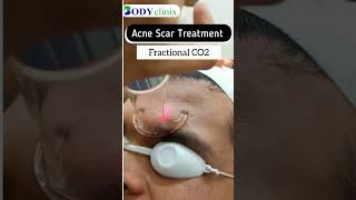 Effective Acne Scar Treatments at BodyClinix  Get Clearer Skin Today [upl. by Frants]