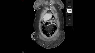 Abdominal Case Conference  442023 [upl. by Goldsmith372]