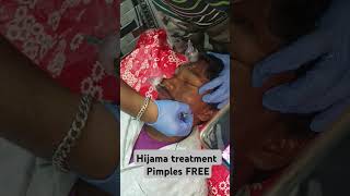 Hijama Treatment for black pimplesDrlaxman samalBALASOREyoutubeshorts shorts [upl. by Eenattirb]