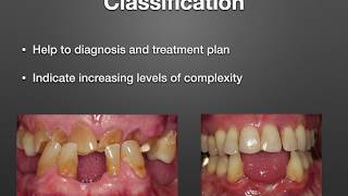 Diagnosis amp Treatment Planning A Prosthodontic Perspective [upl. by Ulla]