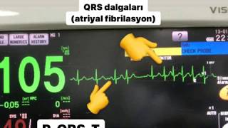 PAROKSİSMAL ATRİYAL FİBRİLASYON MONİTÖR ÖRNEĞİ [upl. by Bose]