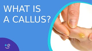 What is a Callus  Daily Dos of Dermatology [upl. by Anyer703]