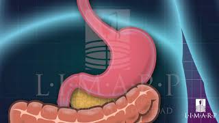 Intragastric Balloon Tijuana México  LIMARP  DR POMPA [upl. by Burrus]