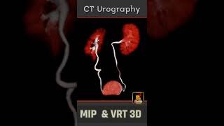 CT Urography  MIP amp VRT 3D  Rad Shorts [upl. by Ahseim809]