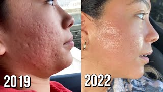 Microneedling Session 8 Before  After [upl. by Sylvan]