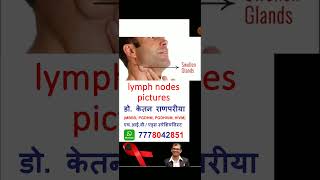 lymph nodes picture hiv hivsymptoms hivtest [upl. by Cello]