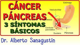 3 Síntomas del CÁNCER DE PÁNCREAS [upl. by Yasdnil]