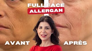 Full Face Allergan 💉✨ [upl. by Rekoob]