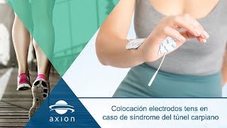 Colocación electrodos TENS para síndrome del túnel carpiano  Electroestimulación TENS [upl. by Andromada]