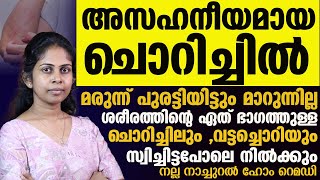 വട്ടച്ചൊറിയും ചൊറിച്ചിലും മാറ്റാൻ നല്ല നാച്ചുറൽ ഹോം റെമഡി ഇതാChorichil Maattaan [upl. by Kehsihba]