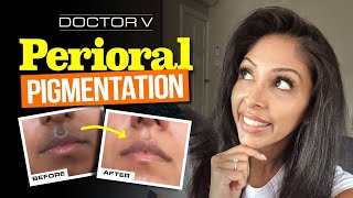 Doctor V  Perioral Pigmentation  Skin Of Colour  Brown Or Black Skin [upl. by Timothy]