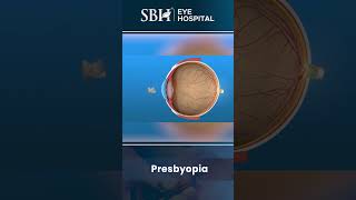 Presbyopia  What is presbyopia  SBH Hospital  Chhattisgarh [upl. by Nakhsa]