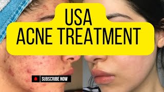 Top Acne Treatment Tips for Clear SkinUnited States Acne Treatment [upl. by Loni441]