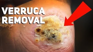 How to Get Rid of Plantar Warts at Home [upl. by Maritsa595]