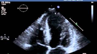 Transthoracic Echocardiographic Images Obtained after Cardiac Catheterization [upl. by Korb]