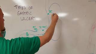 Types of Gastric Stomach Ulcers [upl. by Aruat]