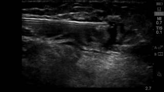 Ultrasound guided saphenous nerve block below knee joint [upl. by Domeniga181]