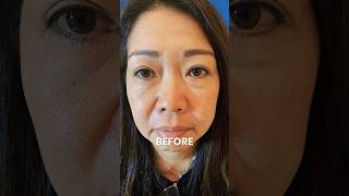 PDO Thread Lift Before and After PCH MedSpa Orange County [upl. by Idnerb]