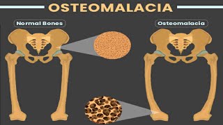 OSTEOMALACIA [upl. by Sherilyn]