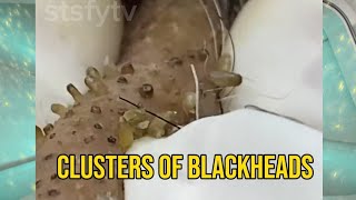 Clusters of Old Age Blackheads  Satisfying  ASMR blackheads blackheadremoval satisfying [upl. by Rechaba]