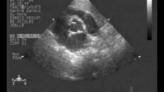 echocardiogram multiple rhabdomyoma tumor  short axis view [upl. by Abijah]