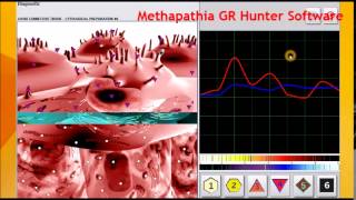 Atheromatous Aorta Medicomat Aorta Treatment [upl. by Nial]