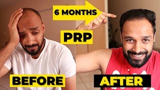 ✅ PRP 6 MONTH RESULTS  3 PRP sessions  HAIR TRANSPLANT vs PRP which one should you really go for [upl. by Ledarf741]