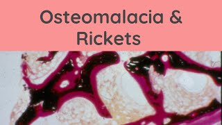 Osteomalacia and Rickets  Pathology mini tutorials [upl. by Diba]