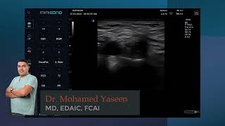 Ultrasound guided supraclavicular nerve block [upl. by Caril]