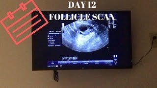 DAY 12 FOLLICLE SCAN [upl. by Enidualc]